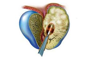 prostatitis akutuaren agerpena