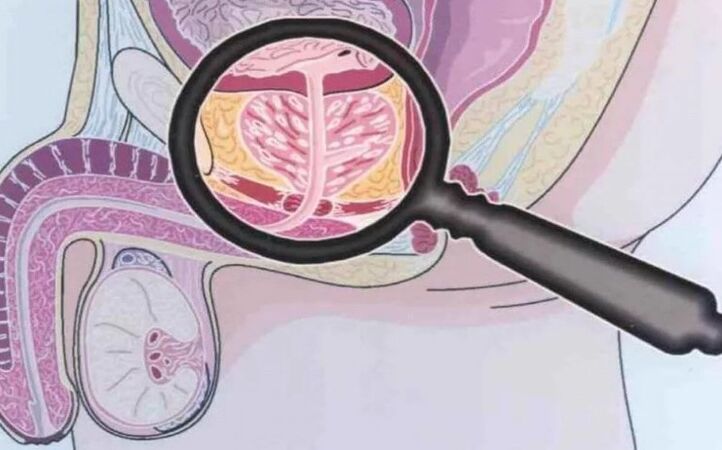Prostatitis kronikoa