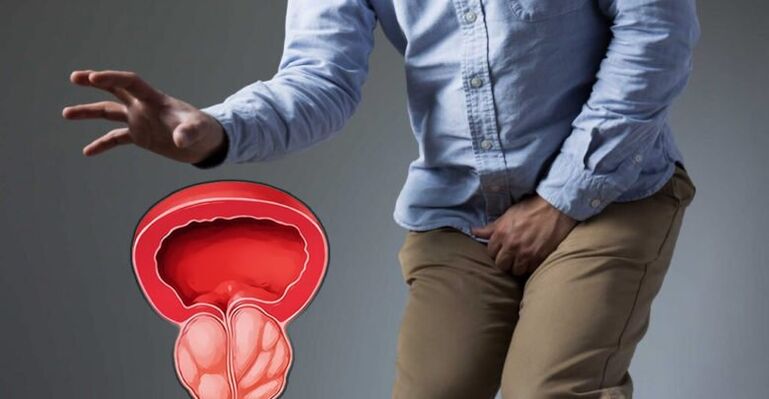 Prostatitisaren prebentzioa eta prostatako adenoma