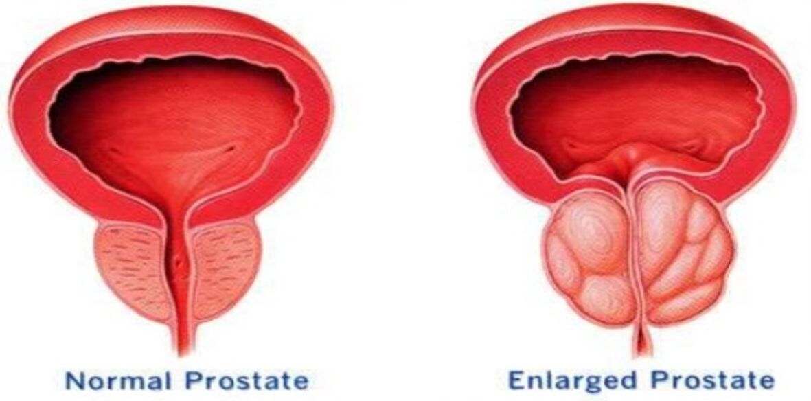 Prostatako normala, puztutako prostata